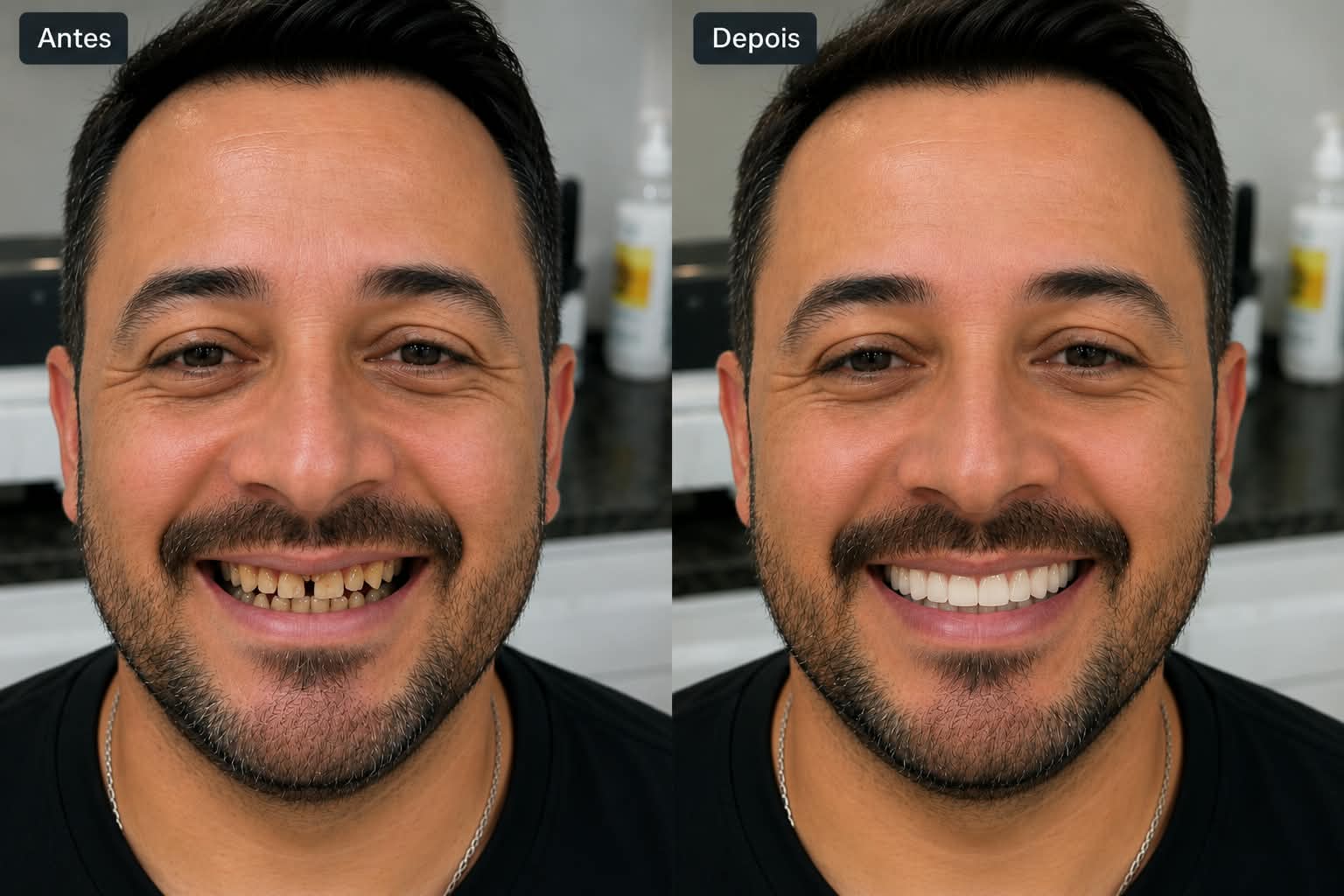 Antes e depois — Facetas